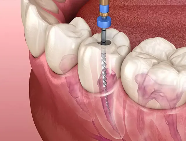 Root canal therapy at YEC Dentistry in Midtown Toronto