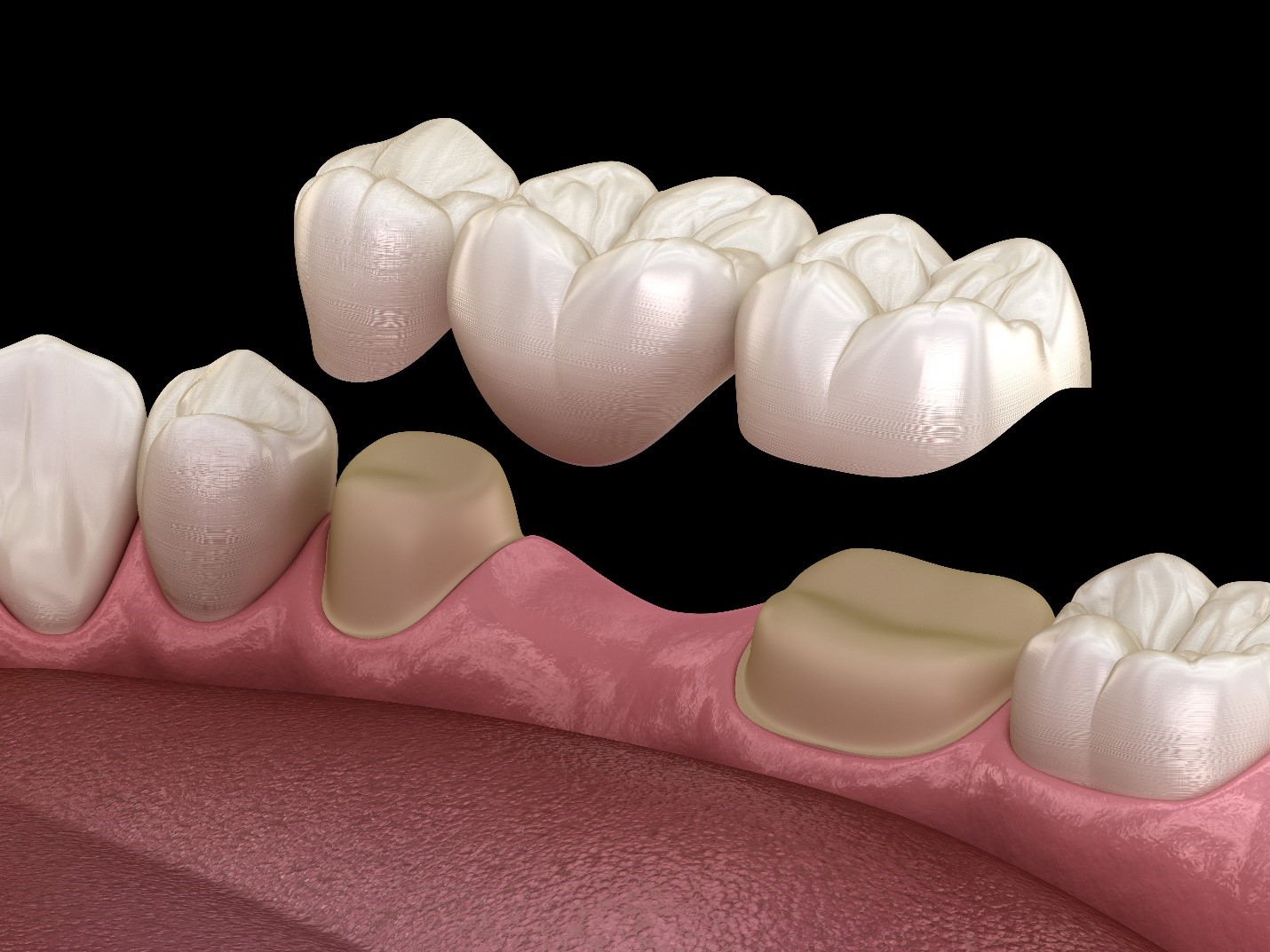 Root canal therapy at YEC Dentistry in Midtown Toronto