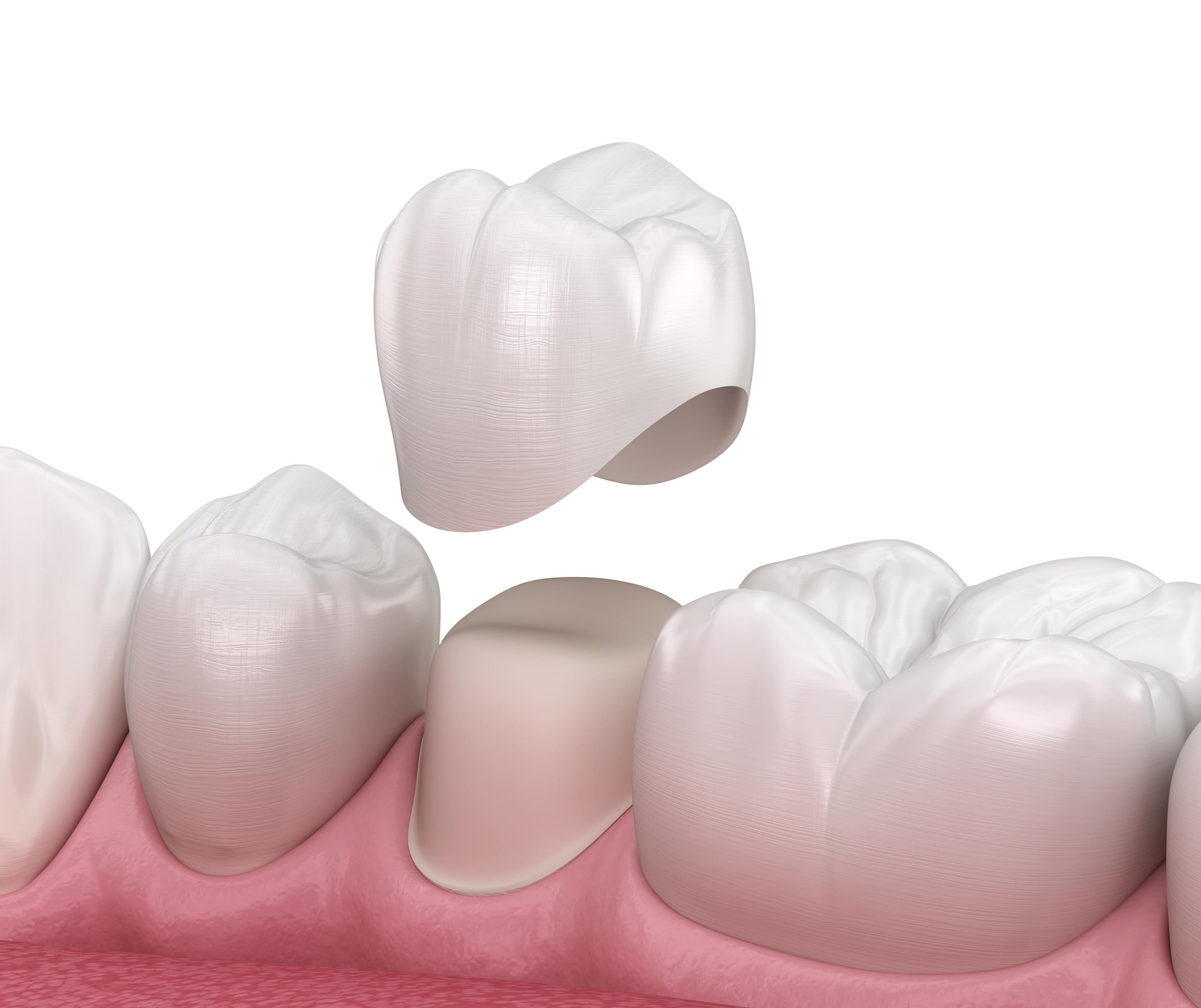 Dentist placing a custom porcelain dental crown to restore a damaged tooth at YEC Dentistry in Toronto