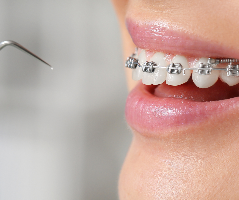 Root canal therapy at YEC Dentistry in Midtown Toronto