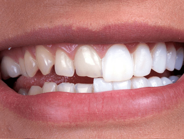 Dentist placing a custom porcelain dental crown to restore a damaged tooth at YEC Dentistry in Toronto