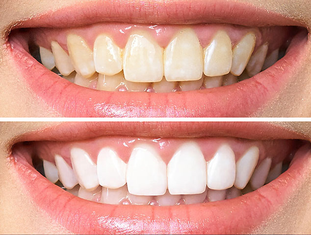 Root canal therapy at YEC Dentistry in Midtown Toronto