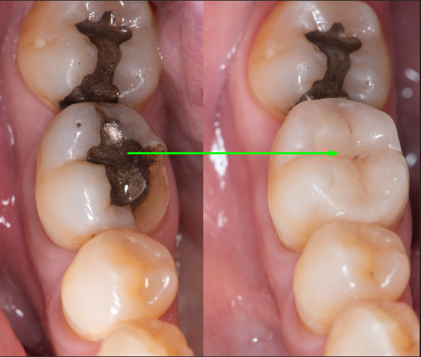 Root canal therapy at YEC Dentistry in Midtown Toronto