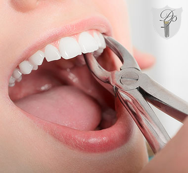 Root canal therapy at YEC Dentistry in Midtown Toronto